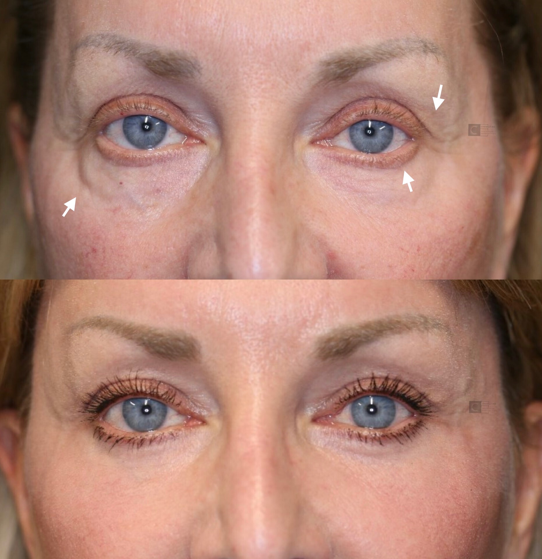 Blepharoplasty Eyelid Surgery in Gilbert AZ