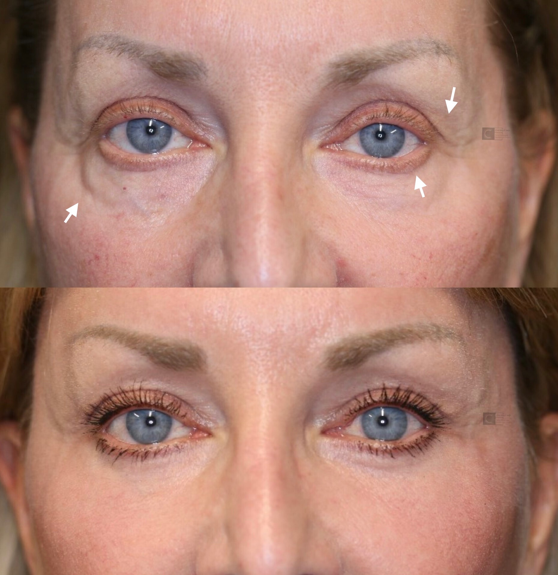 Eye Bag Removal Spokane Eye Bag Enigma Lift Spokane