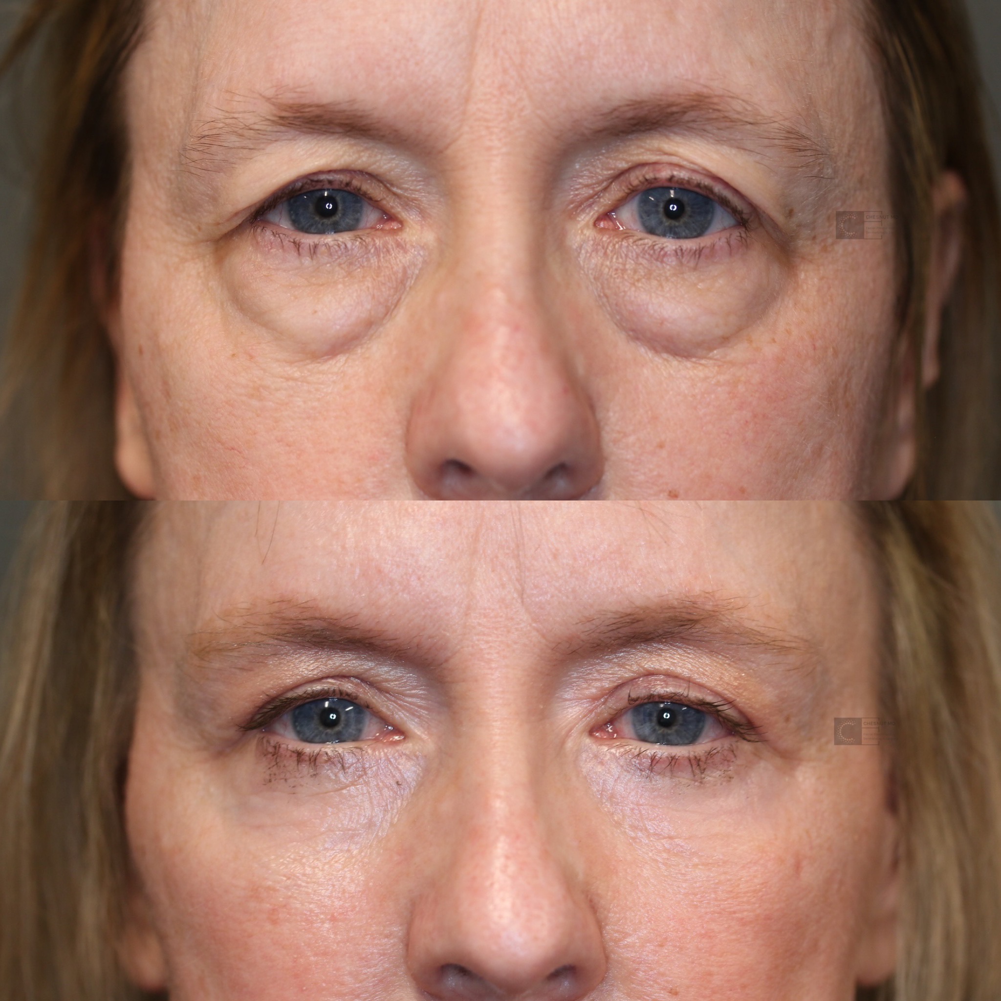 Eye Bag Removal Spokane Eye Bag Enigma Lift Spokane