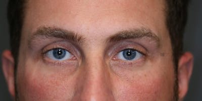 ÔPTIMized Facial Fat Transfer Before & After Gallery - Patient 123022989 - Image 1