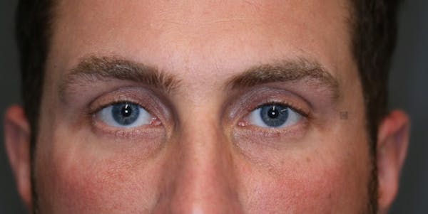 ÔPTIMized Facial Fat Transfer Before & After Gallery - Patient 123022989 - Image 1