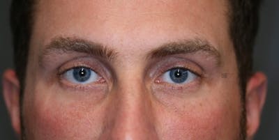 EnigmaLift - Eye Bag Removal Gallery - Patient 123022994 - Image 1