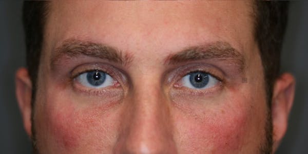 ÔPTIMized Facial Fat Transfer Before & After Gallery - Patient 123022989 - Image 3