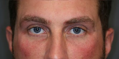  EnigmaLift - Upper Eyelid Surgery Before & After Gallery - Patient 123001993 - Image 4