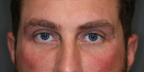 EnigmaLift - Eye Bag Removal Before & After Gallery - Patient 123022994 - Image 4