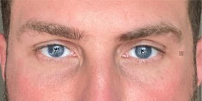 EnigmaLift - Eye Bag Removal Before & After Gallery - Patient 123022994 - Image 2