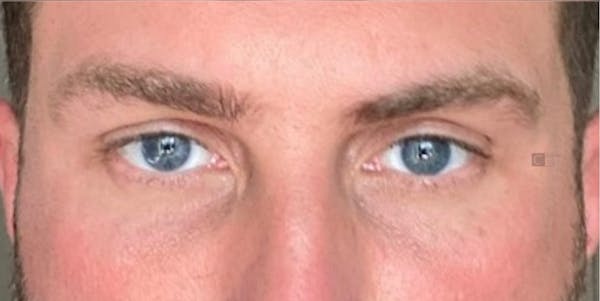  EnigmaLift - Upper Eyelid Surgery Before & After Gallery - Patient 123001993 - Image 2