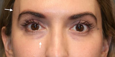 Tear Trough Correction Before & After Gallery - Patient 123023052 - Image 1