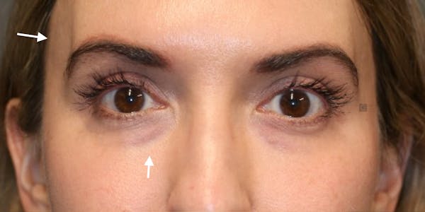 Tear Trough Correction Before & After Gallery - Patient 123023052 - Image 1