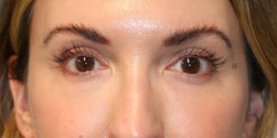 Tear Trough Correction Before & After Gallery - Patient 123023052 - Image 2