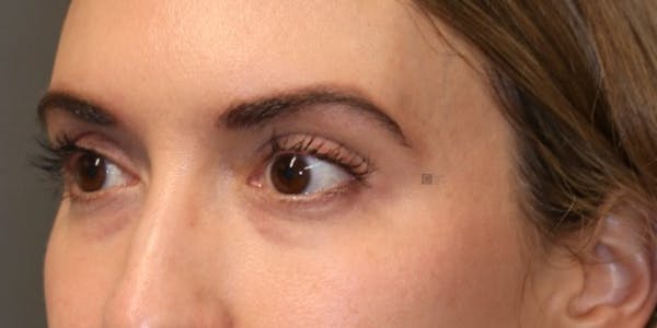 Tear Trough Correction Before & After Gallery - Patient 123023052 - Image 5