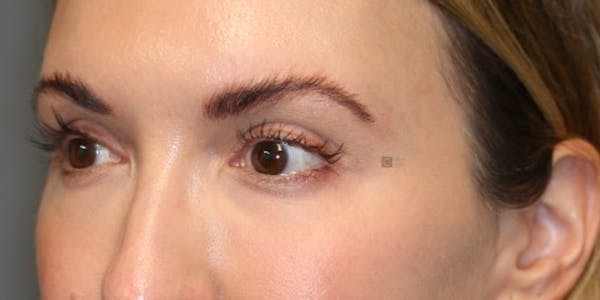 Tear Trough Correction Before & After Gallery - Patient 123023052 - Image 6