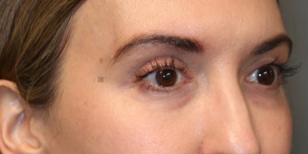 Dermal Fillers Before & After Gallery - Patient 123023020 - Image 5