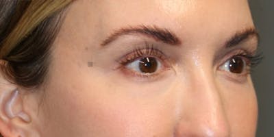 Tear Trough Correction Before & After Gallery - Patient 123023052 - Image 4