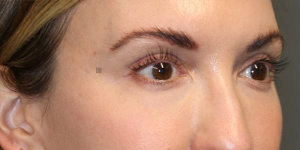 Tear Trough Correction Before & After Gallery - Patient 123023052 - Image 4