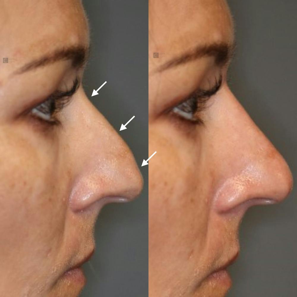 Non-Surgical Rhinoplasty Before & After Gallery - Patient 123023056 - Image 1