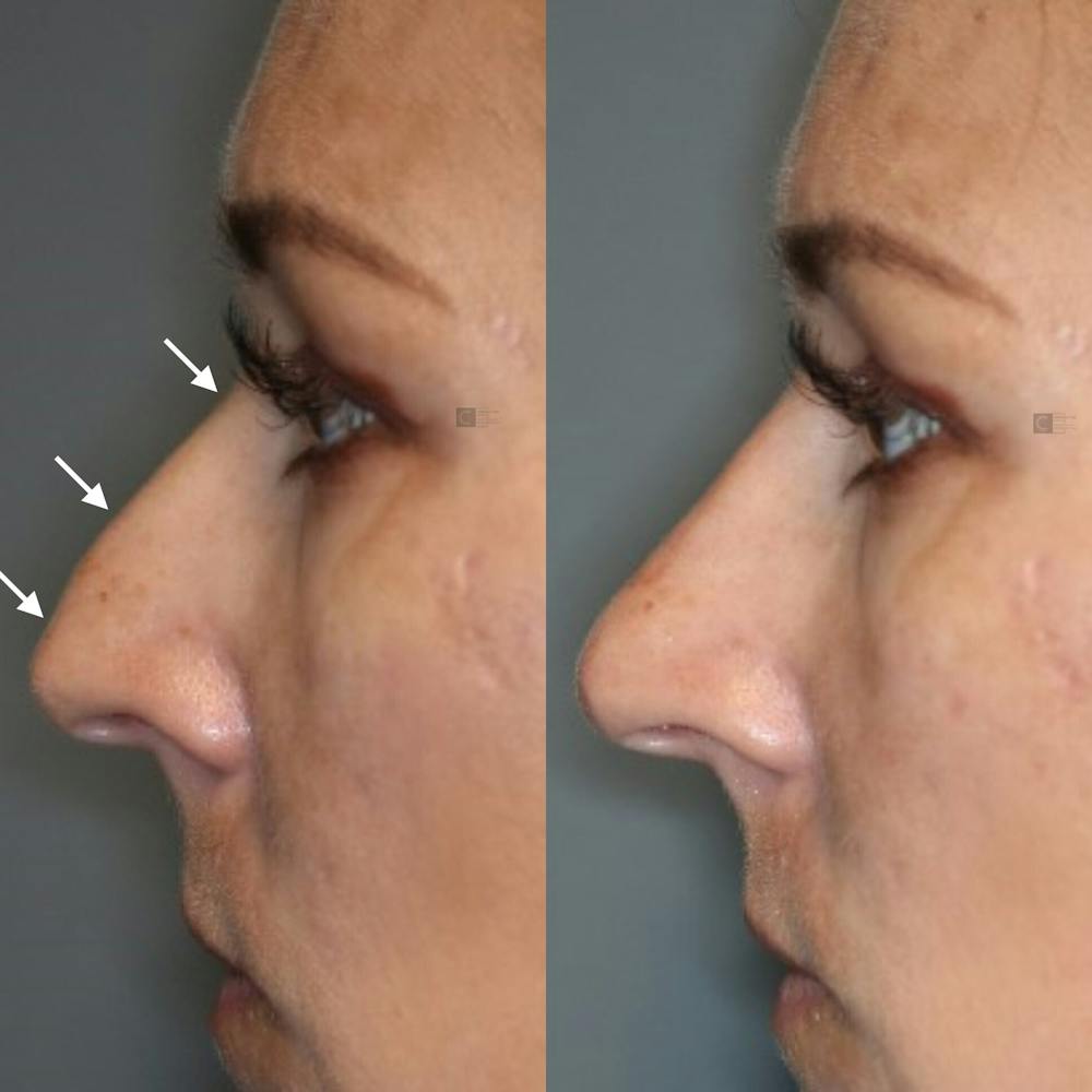 Non-Surgical Rhinoplasty Gallery - Patient 123023056 - Image 2