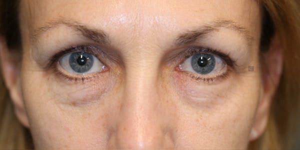 EnigmaLift - Eye Bag Removal Before & After Gallery - Patient 123023589 - Image 1