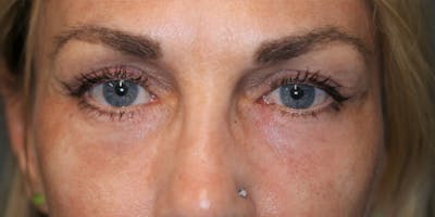  EnigmaLift - Upper Eyelid Surgery Before & After Gallery - Patient 123023582 - Image 2