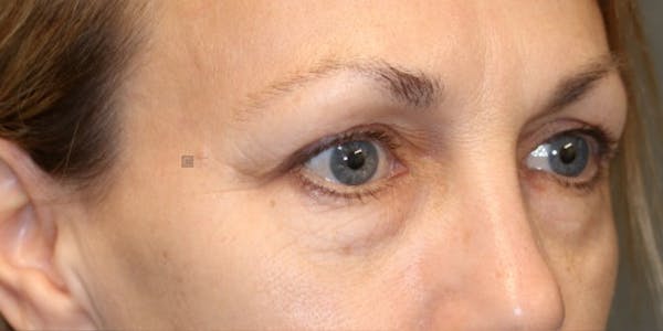 EnigmaLift - Brow Lift Before & After Gallery - Patient 123023579 - Image 3