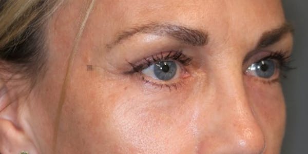  EnigmaLift - Upper Eyelid Surgery Before & After Gallery - Patient 123023582 - Image 4