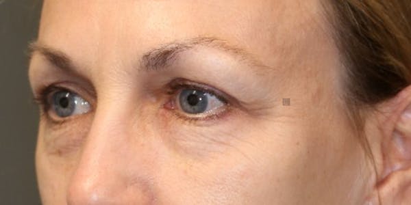 EnigmaLift - Eye Bag Removal Gallery - Patient 123023589 - Image 5