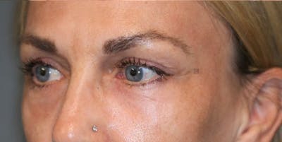 EnigmaLift - Eye Bag Removal Before & After Gallery - Patient 123023589 - Image 6