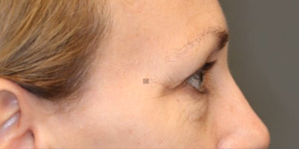 EnigmaLift - Mid Face Lift Before & After Gallery - Patient 123023645 - Image 7