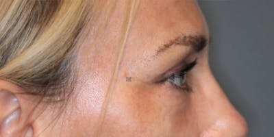 EnigmaLift - Eye Bag Removal Before & After Gallery - Patient 123023589 - Image 8