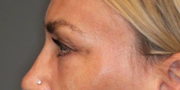 EnigmaLift - Brow Lift Gallery - Patient 123023579 - Image 10