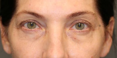 ÔPTIMized Facial Fat Transfer Before & After Gallery - Patient 123023661 - Image 1