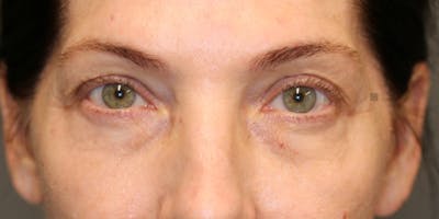 EnigmaLift - Brow Lift Gallery - Patient 123023658 - Image 1