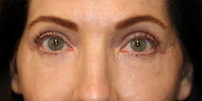 ÔPTIMized Facial Fat Transfer Before & After Gallery - Patient 123023661 - Image 2