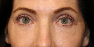 EnigmaLift - Eye Bag Removal Before & After Gallery - Patient 123023660 - Image 2