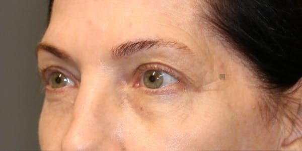 EnigmaLift - Eye Bag Removal Before & After Gallery - Patient 123023660 - Image 3
