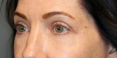 EnigmaLift - Brow Lift Gallery - Patient 123023658 - Image 4