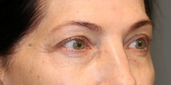 EnigmaLift - Brow Lift Before & After Gallery - Patient 123023658 - Image 5