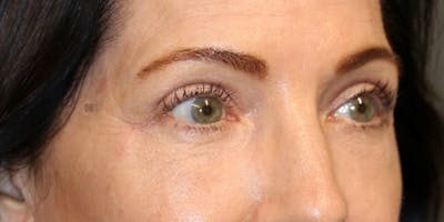  EnigmaLift - Upper Eyelid Surgery Before & After Gallery - Patient 123023659 - Image 6
