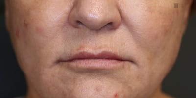 LoveLift - Lip Lift Before & After Gallery - Patient 123023677 - Image 1
