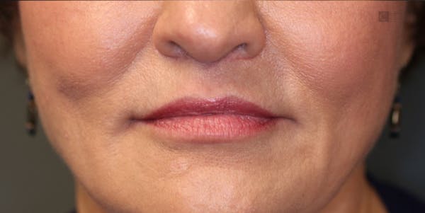 LoveLift - Lip Lift Before & After Gallery - Patient 123023677 - Image 2