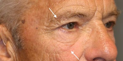  EnigmaLift - Upper Eyelid Surgery Before & After Gallery - Patient 123023680 - Image 1
