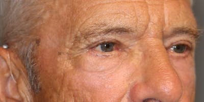  EnigmaLift - Upper Eyelid Surgery Before & After Gallery - Patient 123023680 - Image 2