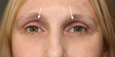 ÔPTIMized Laser Cocktail Before & After Gallery - Patient 123023715 - Image 1
