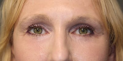  EnigmaLift - Upper Eyelid Surgery Gallery - Patient 123023711 - Image 2