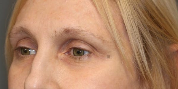 ÔPTIMized Laser Cocktail Before & After Gallery - Patient 123023715 - Image 3