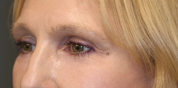 EnigmaLift - Eye Bag Removal Gallery - Patient 123023714 - Image 4