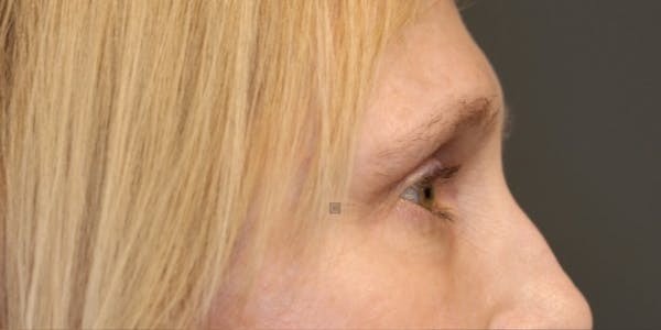 ÔPTIMized Laser Cocktail Before & After Gallery - Patient 123023715 - Image 5