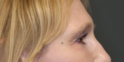  EnigmaLift - Upper Eyelid Surgery Before & After Gallery - Patient 123023711 - Image 6