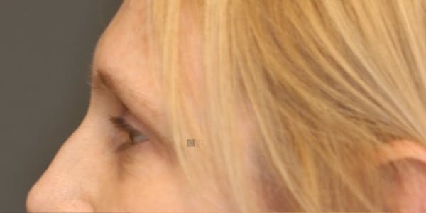 EnigmaLift - Eye Bag Removal Before & After Gallery - Patient 123023714 - Image 7