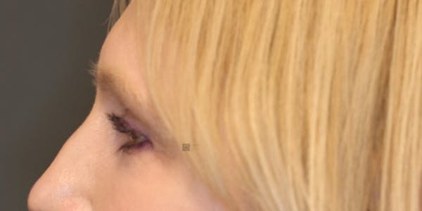  EnigmaLift - Upper Eyelid Surgery Before & After Gallery - Patient 123023711 - Image 8